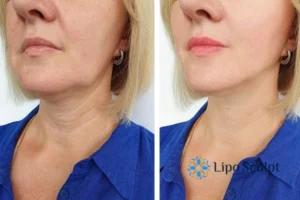 Double chin before and after Hi-Fu treatment 4 Book your double chin treatment Barr Common today! We are here to help!