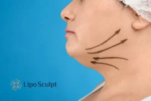 Double chin before and after Hi-Fu treatment 3 Boost your confidence with a Double chin treatment Barr Common