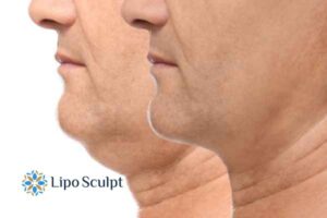 Double chin before and after Hi-Fu treatment 2 Double chin treatment Barr Common from Lipo Sculpt - feel more confident today!