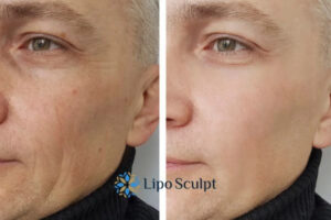 How to Fight Aging Symptoms 3 Fight Aging Symptoms Barr Common With HIFU and Morpheus8 Today!