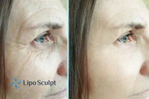 How to Fight Aging Symptoms 2 Do you want to Fight Aging Symptoms Barr Common? Contact Lipo Sculpt today!