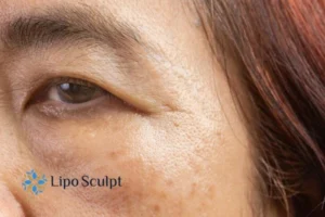 Cryopen: The Revolutionary Treatment for Age Spots Unveiled 2 Are age spots Barr Common giving you low self esteem? Contact us today!