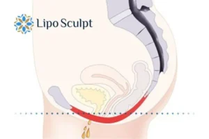 Pelvic Floor Chair Therapy 1 Pelvic Floor Chair Therapy Barr Common to treat incontinence.