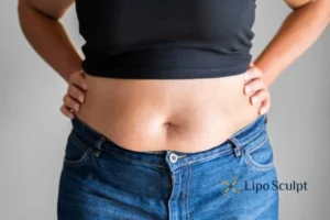 Bidding Farewell to Muffin Tops with Aqualyx Fat Injections 2 Do you wish you could reduce your muffin top Barr Common With Aqualy fat dissolving injections you can!