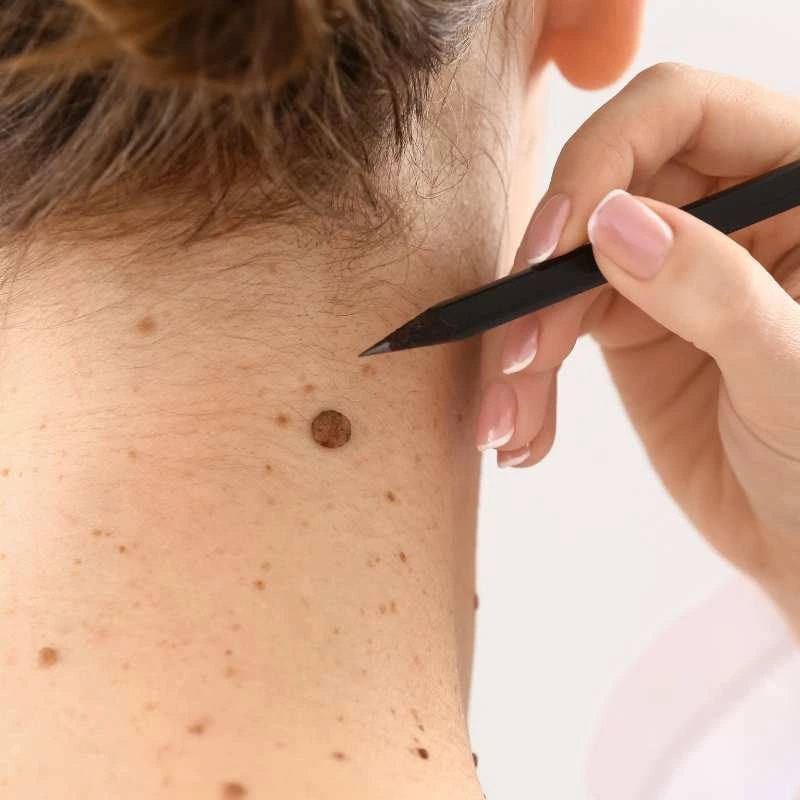 How to Support Your Body During Pregnancy for Faster Postnatal Recovery 5 See our lesion removal prices Barr Common - call today for a free quote